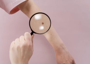 5 Signs that Your Melanoma is Spreading