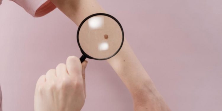 5 Signs that Your Melanoma is Spreading