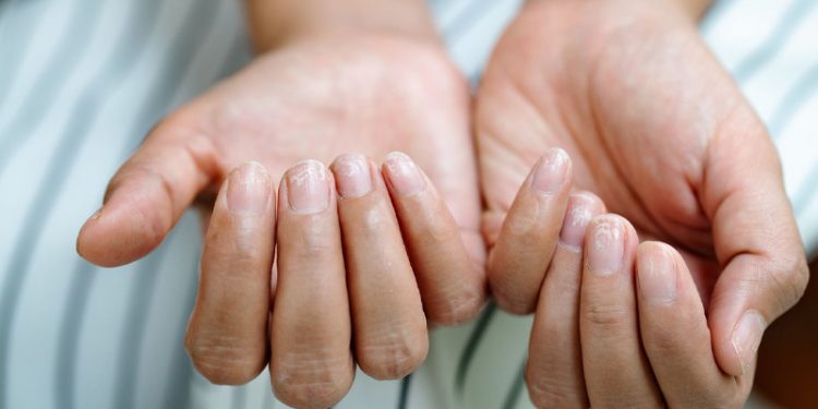 get-checked-for-cancer-if-you-see-this-on-your-fingernails-biglaps