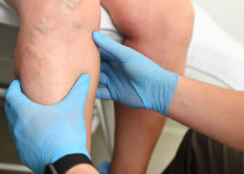 Warning Signs That Your Visible Veins Give, Doctors Explain