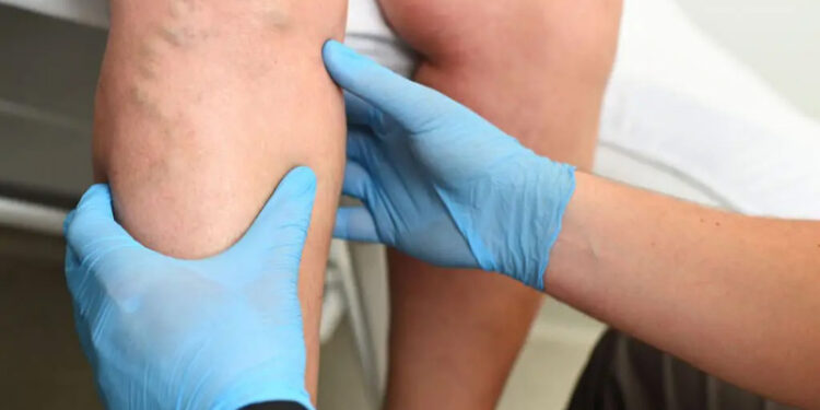 Warning Signs That Your Visible Veins Give, Doctors Explain