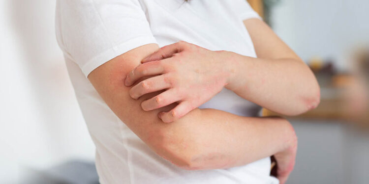 CDC Warns of Public Health Threat: Spreading Skin Infection