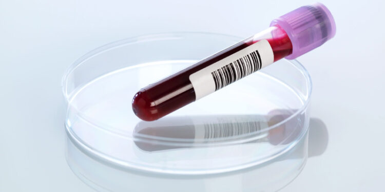 This New Blood Test Can Detect Risk for Alzheimer’s!