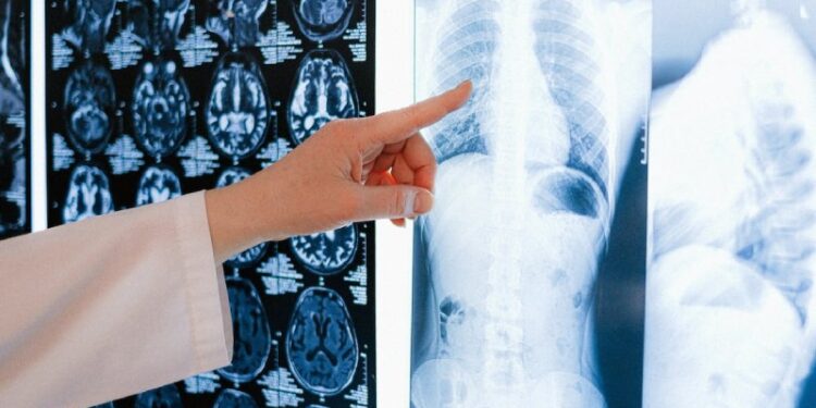 11 Alarming Indicators of Lung Cancer You Must Be Aware of