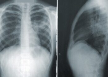If You’re a Woman, Be Wary of These Lung Cancer Signs!