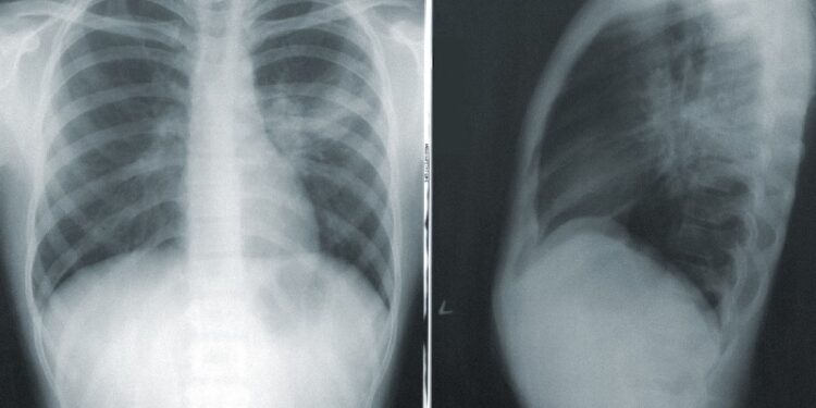 If You’re a Woman, Be Wary of These Lung Cancer Signs!
