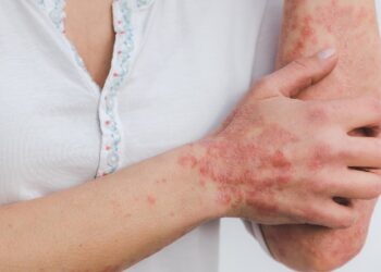 Psoriatic Arthritis Early Symptoms, Diagnosis, and Treatments
