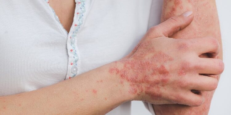 Psoriatic Arthritis Early Symptoms, Diagnosis, and Treatments