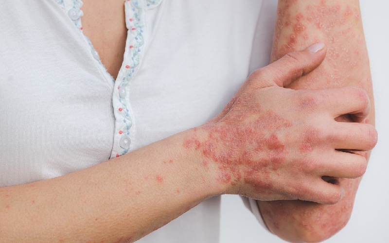 Psoriatic Arthritis Early Symptoms, Diagnosis, and Treatments