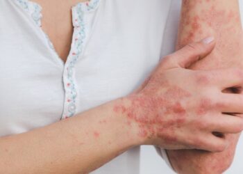 Compilation of 11 Adult Skin Problems Widely Spread Among People